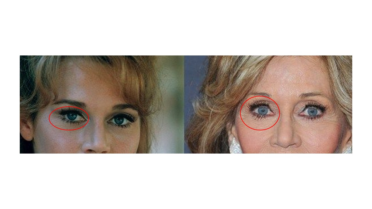 Close-up of Jane Fonda's eyes with oval drawn to illustrate orbital oval theory — the oval is larger in the older photo