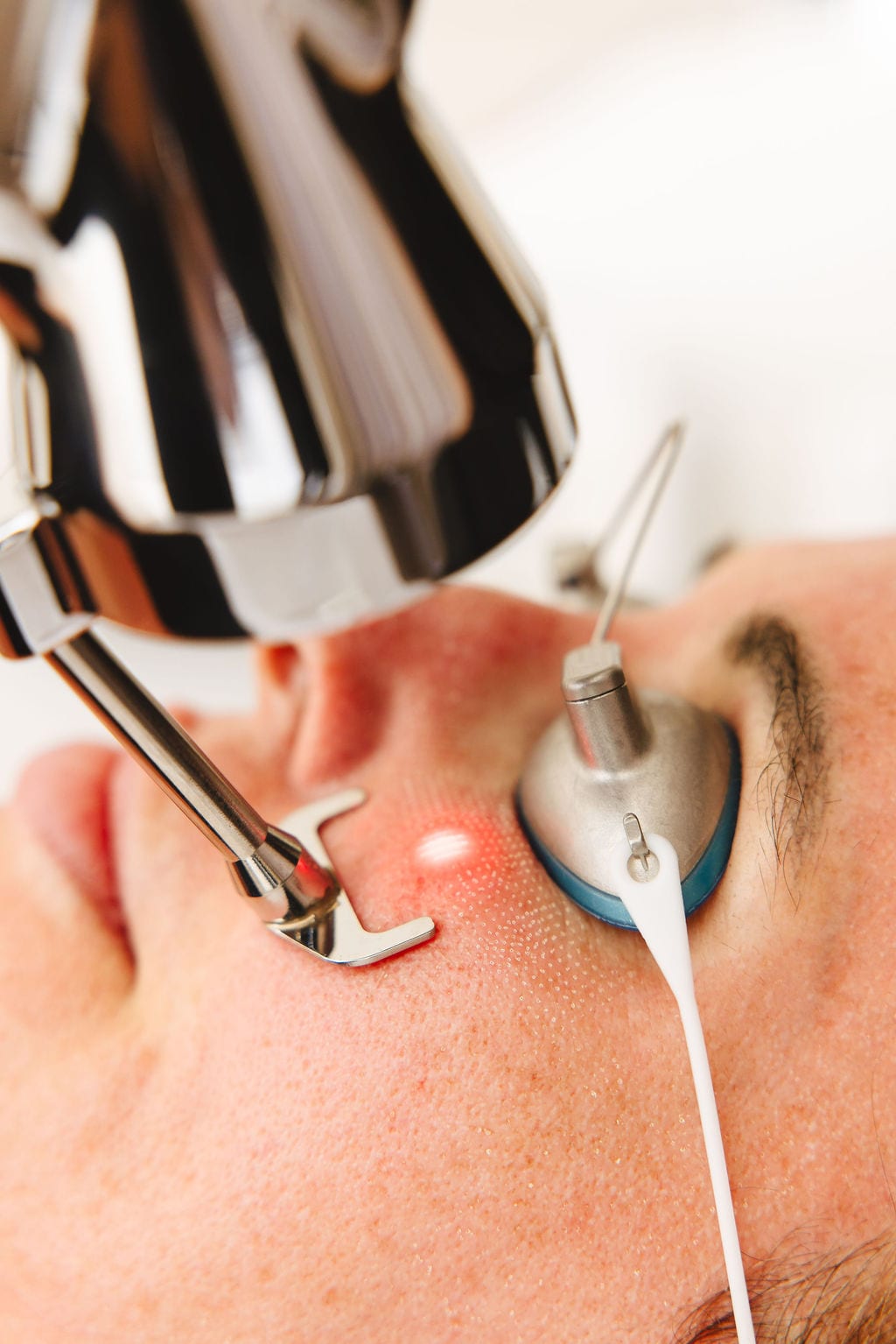 ProFractional laser scar treatment at Treasure Valley Medical Spa