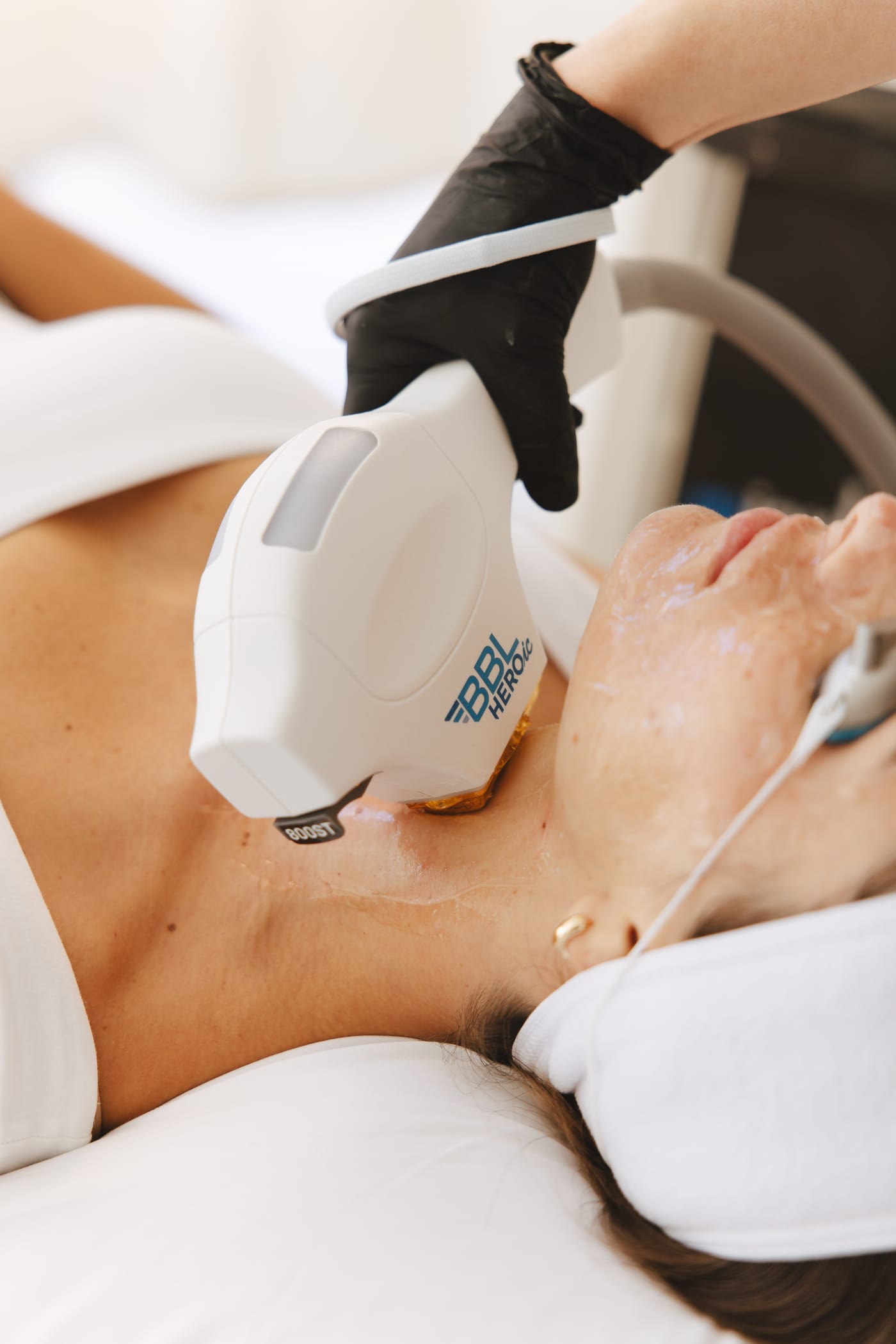 BBL HEROic treatment being performed on patient's neck and chest area