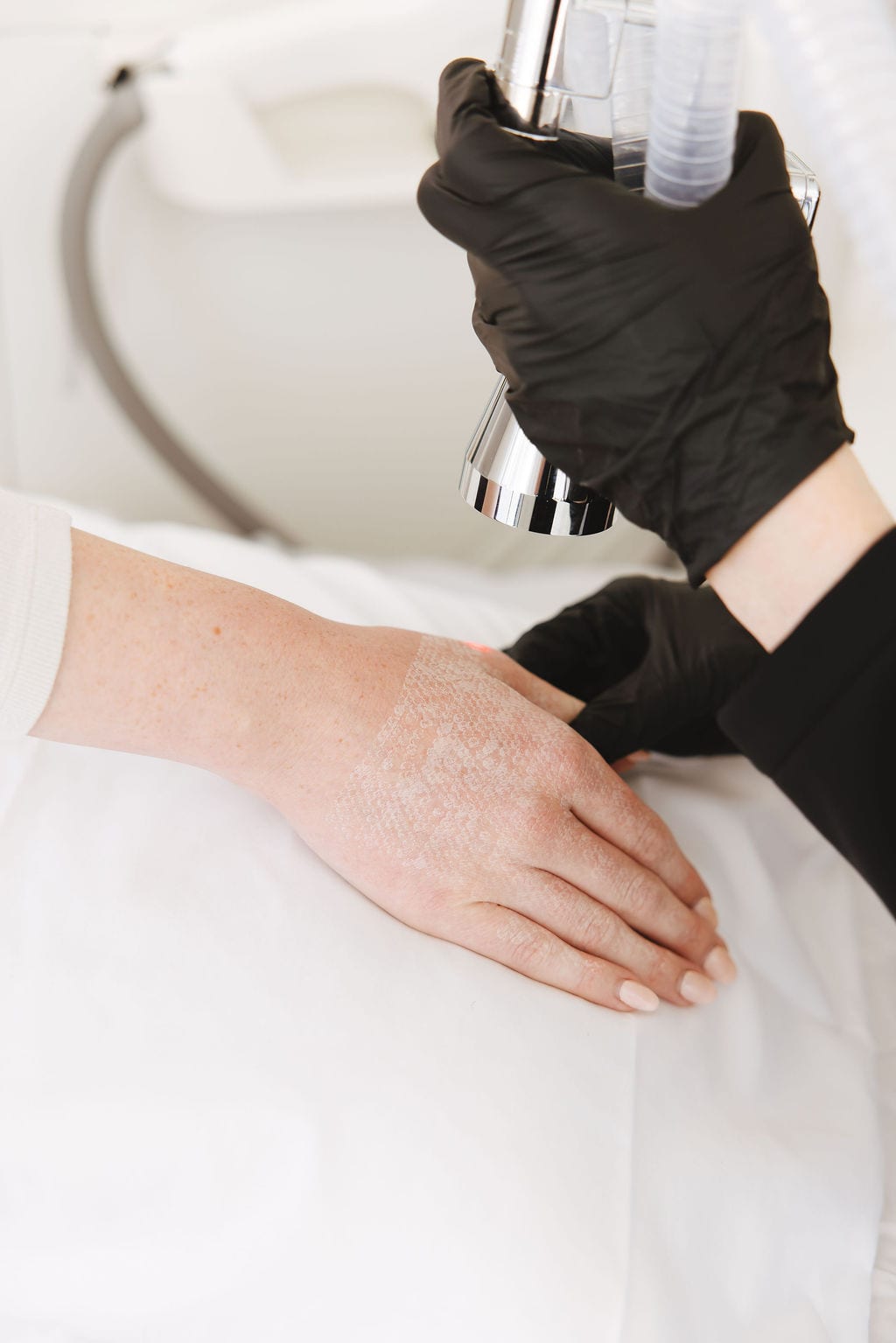 Laser skin resurfacing close-up