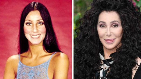 Cher young vs older — illustrating upper eyelid hollowness that develops with age