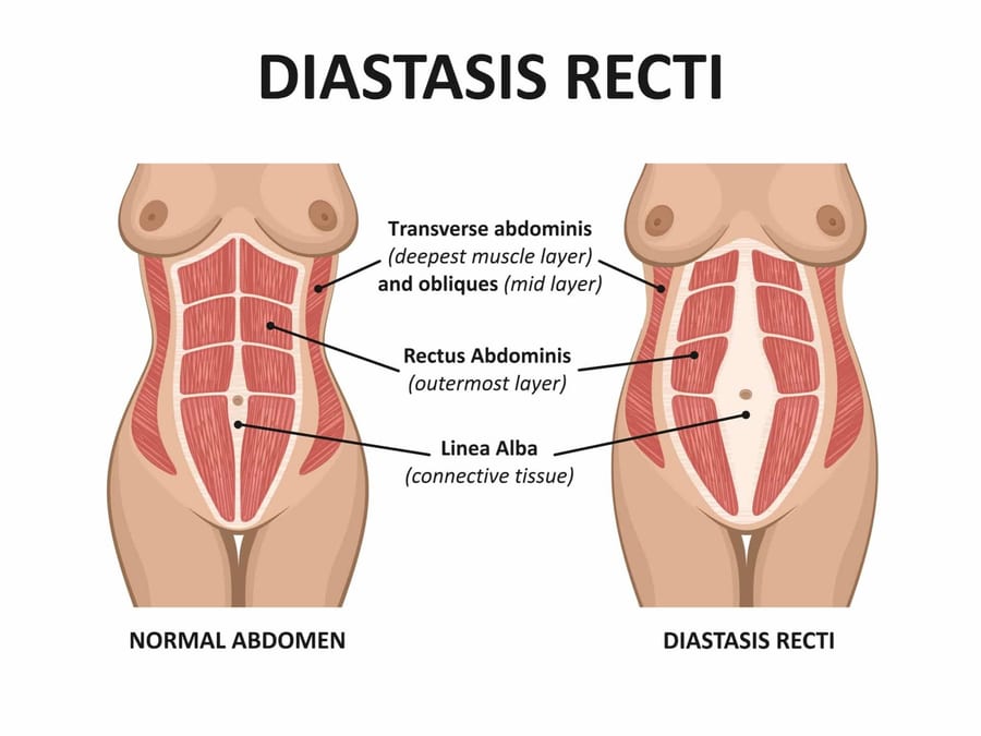 Anatomical diagram comparing a normal abdomen to diastasis recti, showing separation of the rectus abdominus muscles